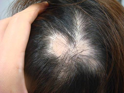 円形脱毛症は頭や眉毛などの顔面の毛が突然円形に抜けてくる病気です。